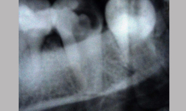 Veneerscrown and bridges treatment in Anand
                        